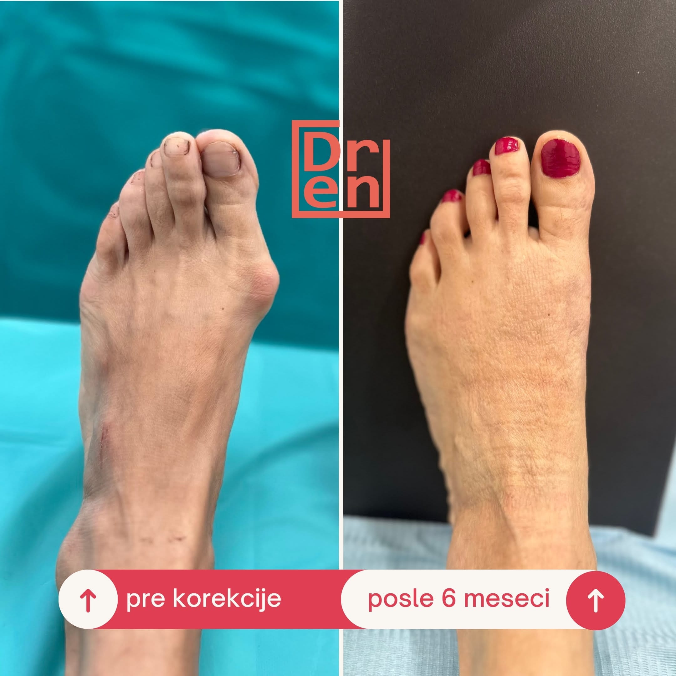 Stopalo sa izraženim čukljem pre operativne korekcije