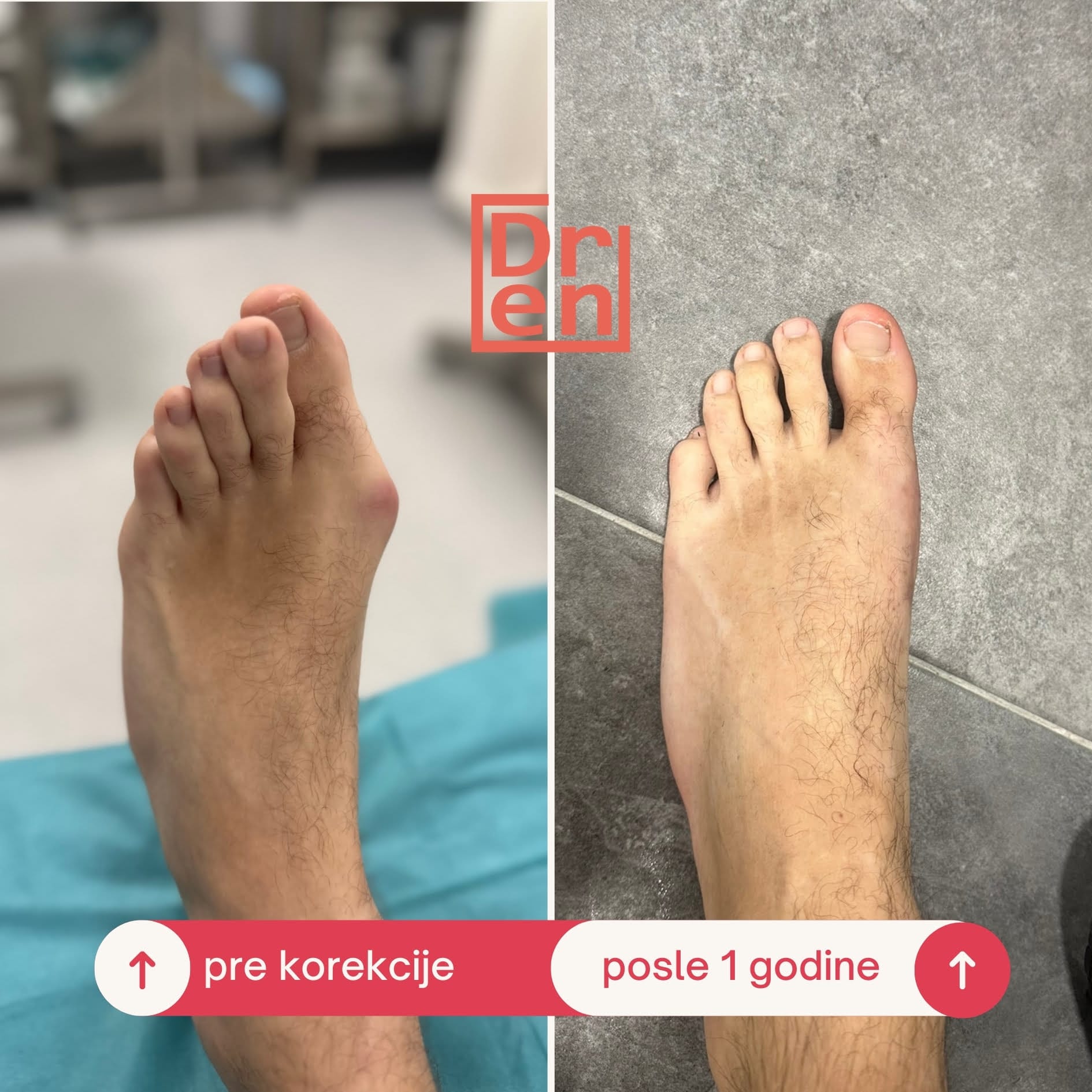 Stopalo godinu dana nakon operacije čuklja